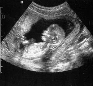 УЗИ на 23 недели беременности