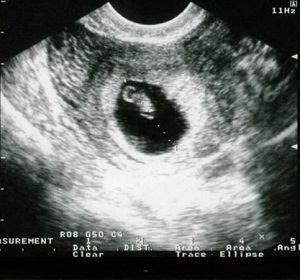 На фото беременность раннего срока