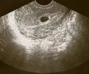 На УЗи видно беременность в матке сроком 4 недели