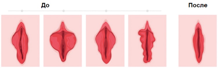Как выглядят половые губы до и после лабиопластики