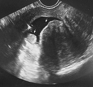 Фотография миомы в полости матки на УЗИ